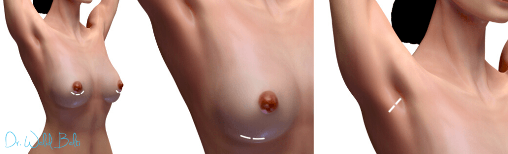 different incision augmentation mammaire tunisie