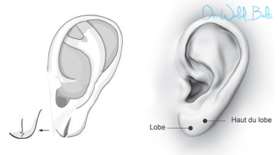 Corriger les déformations des oreilles et l’usure des lobes