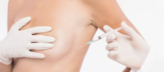 Lipofilling mammaire suite au retrait d'implants mammaires