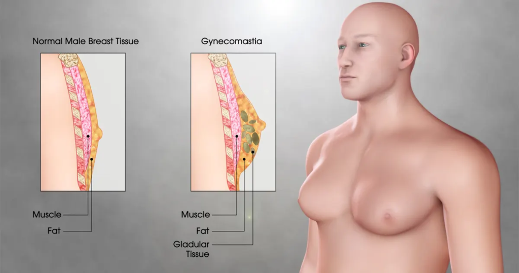 chirurgie-mammaire-masculine-tunisie