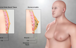 chirurgie-mammaire-masculine-tunisie